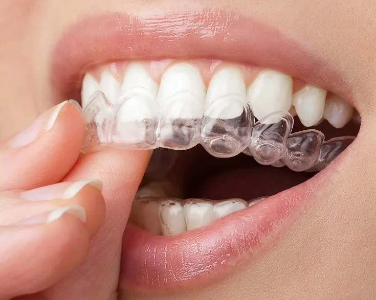 Ortodoncia y Alineadores Invisibles